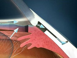 Ospedale Conegliano, un nuovo tipo di intervento microinvasivo per il glaucoma