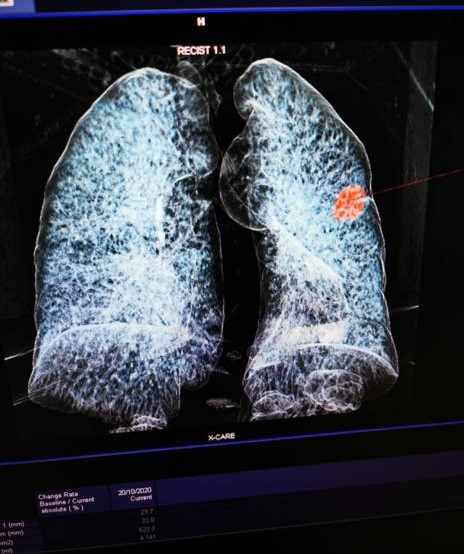 Rilevazione automatica Tumore ai polmoni con nuova TC e software intelligente (2)