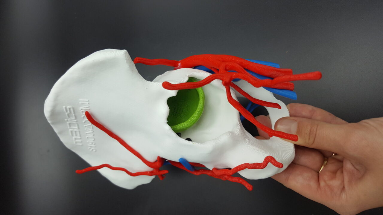 Chirurgia spalla e ginocchio, a Monastier nuova tecnica con modello 3D
