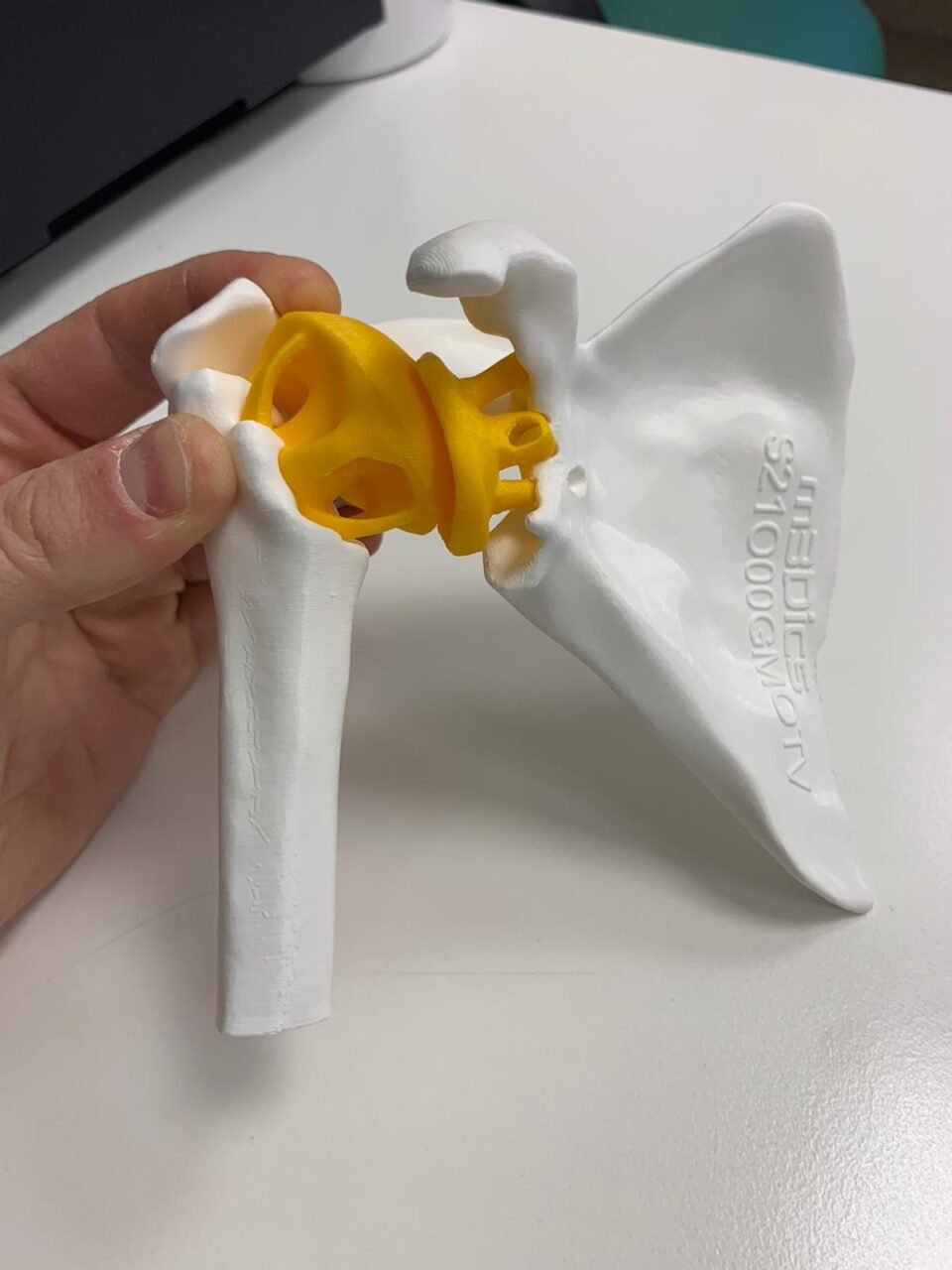 Chirurgia spalla e ginocchio, a Monastier nuova tecnica con modello 3D