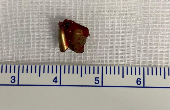 Tenta di far esplodere un proiettile trovato per strada: 17enne rischia di perdere l’occhio