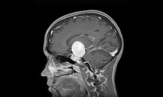 Un “palloncino” di quattro centimetri pronto ad esplodere nel cervello: 24enne di Treviso rischia la vita per un aneurisma gigante