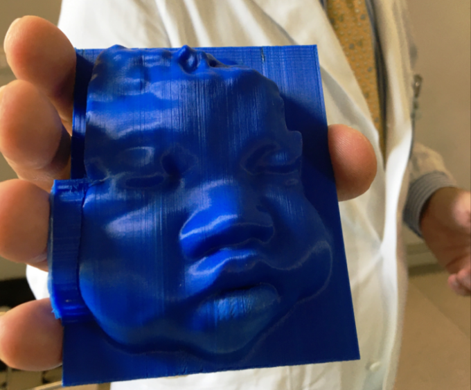 All’Ospedale di Conegliano ecografie in 3D per i genitori ipovedenti